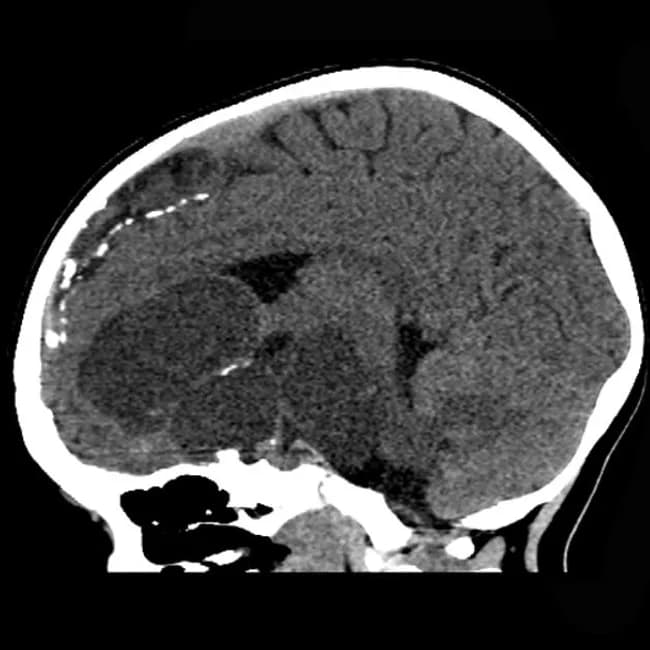 Computed Tomography (CT) of the pediatric brain, non-contrast, sagittal orientation, reveals a large suprasellar multicystic lesion with punctate and coarse calcifications. The mass occupies the sellar/suprasellar space, abutting the hypothalamic-pituitary axis, and extends into the middle cranial fossa with midline shift and displacement of the optic apparatus. The lesion displays mixed density with cystic components and calcified nodules, a hallmark of adamantinomatous craniopharyngioma in children. There may be secondary hydrocephalus from obstruction of the third ventricle. The neuroimaging phenotype includes multicystic architecture, calcifications, and suprasellar location; these findings strongly support a craniopharyngioma over other posterior fossa or suprasellar tumors. The resection specimen confirmed adamantinomatous histology, with characteristic squamous epithelium and calcified enamel-like nodules. Clinically relevant diagnosis includes pediatric brain tumor with potential endocrine dysfunction and visual compromise. Differential diagnoses to consider include germinoma and pilocytic astrocytoma in the pediatric population. This case demonstrates the quintessential radiologic signature of adamantinomatous craniopharyngioma and highlights the necessity of correlating CT findings with surgical pathology for definitive diagnosis and guiding therapeutic planning. Correlation with endocrinology imaging is essential to assess pituitary function; follow-up MRI is recommended to evaluate residual/recurrent disease; treatment typically involves subtotal resection with possible adjuvant radiotherapy and endocrinology management.