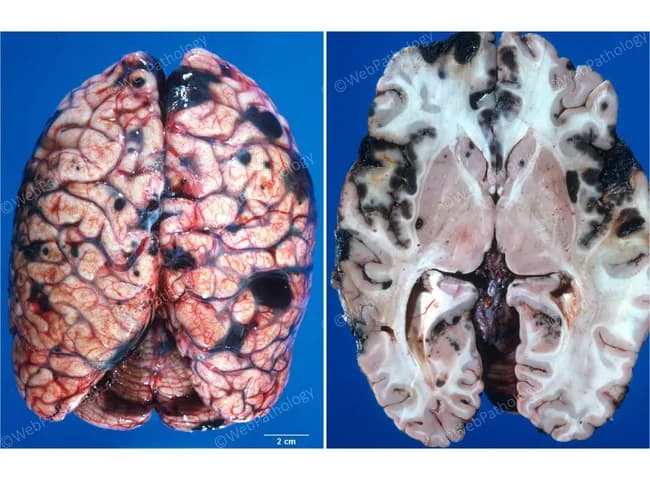Gross pathology photograph of ex vivo brain tissue showing coronal sections through the cerebral hemispheres. Location: central nervous system with widespread metastatic involvement of cortex and deep white matter. Visual features: numerous pigmented, dark brown to black nodules distributed bilaterally across hemispheres; surface vasculature prominent; some lesions exhibit hemorrhagic foci; pigmentation indicates melanin-rich melanoma metastases. Parenchyma around lesions shows edema with preserved general architecture; size of nodules ranges from millimeters to centimeters; meninges may contain pigmented foci at the periphery. Pathologic correlation: metastatic melanoma to brain commonly produces melanotic deposits that are visibly dark and well-circumscribed within brain tissue; gross findings support histopathology showing melanoma cells with abundant melanin. Diagnostic significance: confirms disseminated cutaneous melanoma with intracranial metastases; implies advanced disease and poor prognosis; necessitates systemic staging and multidisciplinary management. Potential differential diagnoses: pigmented meningioma, pigmented metastases from other primaries, hemorrhagic neoplasms; clinical correlation with history of a large pigmented lesion on the back supports melanoma origin. Clinical utility: educational reference, radiology-pathology correlation, and prognosis discussion; informs treatment planning including consideration of stereotactic radiosurgery, whole-brain radiotherapy, and systemic immunotherapy. This image sequence serves as a baseline for comparative pathology in melanoma metastasis studies. Useful for tumor biology and educational applications.