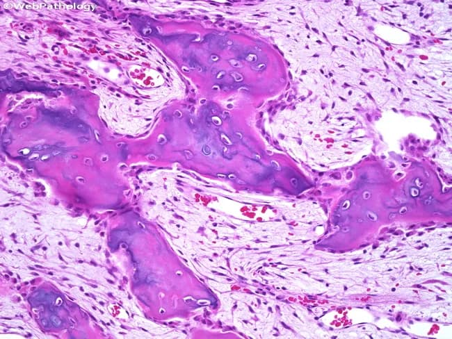 This is a histopathology image obtained from a periosteal bone lesion, analyzed by light microscopy after Hematoxylin and Eosin (H&E) staining. The specimen demonstrates a densely cellular spindle cell proliferation embedded in a fibrous stroma that interposes between irregular bone trabeculae at the periosteal surface. The bony trabeculae are variably mineralized, with woven and trabecular components intermixed with the soft tissue spindle cells, creating a biphasic pattern characteristic of BPOP (Bizarre Parosteal Osteochondromatous Proliferation), also known as Nora lesion. The spindle cells are uniform, spindle‑shaped mesenchymal cells with elongated nuclei and scant cytoplasm; mitotic activity is minimal or absent, and cytologic atypia is not evident. Surrounding cartilaginous nodules or a cartilaginous cap may be seen in some instances; there is no infiltration of adjacent marrow or invasion beyond the periosteal surface. The lesion remains largely confined to the surface with fibrous tissue separating osseous trabeculae. Diagnostic significance is that this histology supports a benign proliferative osseous lesion with a known tendency to recur after incomplete excision, but malignant transformation has not been reported. Clinically, recognition of BPOP guides surgical management toward complete excision with clear margins to reduce recurrence risk; differential considerations include osteochondroma and periosteal chondrosarcoma. This image is valuable for educational pathology discussions.