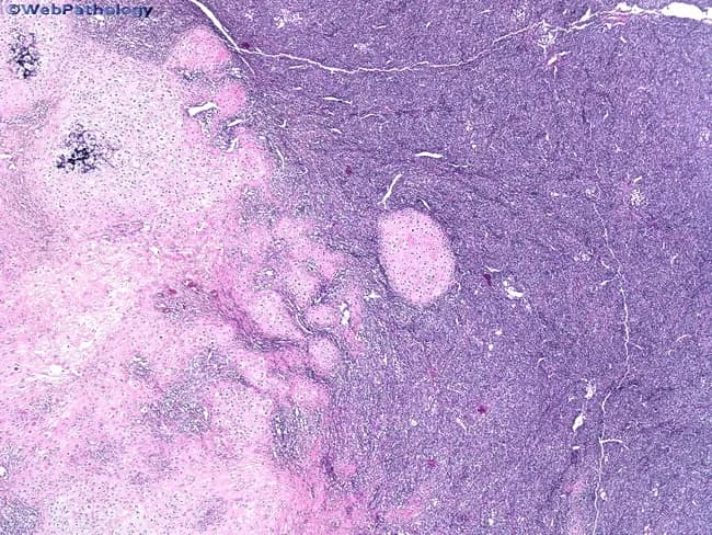 Imaging modality: Light microscopy of Hematoxylin and Eosin stained tissue section, bright-field illumination. This histopathology image demonstrates a biphasic neoplasm characteristic of mesenchymal chondrosarcoma. The slide shows well-differentiated hyaline cartilage nodules embedded within an intensely cellular undifferentiated mesenchymal stroma. The cartilaginous component exhibits lacunar chondrocytes within a glossy chondroid matrix, occasional binucleation, and chondrocyte maturation features. The adjacent stroma consists of small, round to spindle-shaped cells with scant cytoplasm, hyperchromatic nuclei, and high mitotic activity in focal areas. The boundary between cartilage and stroma is sharply defined, creating a clear demarcation of two distinct tissue compartments. Occasional calcifications or endochondral ossification foci may be present within cartilaginous islands. The overall architecture is lobulated with abrupt juxtaposition of chondroid and primitive mesenchymal elements, and may show areas of necrosis or hemorrhage in larger lesions. Clinically, this biphasic pattern is diagnostic when correlated with immunohistochemistry and radiological data. Differential diagnoses include conventional chondrosarcoma, Ewing sarcoma, and other small round cell tumors with cartilaginous differentiation. The image underscores the diagnostic significance of recognizing dimorphic histology for accurate classification, prognosis, and treatment planning in musculoskeletal oncology. Immunohistochemical profiles may include CD99 positivity in the stroma with variable S-100 expression in cartilage, and variable negativity for cytokeratin.