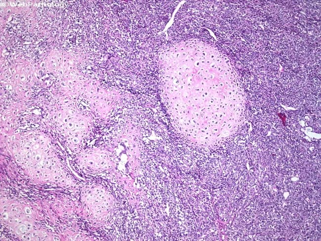 Histopathology slide of cartilaginous tissue showing hyaline-like matrix arranged in lobules with chondrocytes embedded in lacunae. Chondrocytes are occasionally binucleated and dispersed within a basophilic cartilage background, with preserved pericellular matrix surrounding lacunae. The matrix displays chondroid differentiation with subtle myxoid features and scattered calcifications or osseous nodules. In this field, the chondroid regions are relatively well differentiated, yet the morphological pattern may resemble a well-differentiated chondrosarcoma, raising diagnostic challenge. The cellularity is variable, ranging from hypocellular zones to mildly increased cellularity at peripheries, without overt high-grade pleomorphism or mitotic activity in the presented areas. The lesion appears to be infiltrative in a histologic sense only through interface with surrounding stroma; however, definitive malignant behavior requires correlation with radiology and clinical history. Notable features include cartilaginous matrices with lacunar chondrocytes, occasional binucleation, calcified foci, and potential ossification. This image underscores the need for contextual evaluation to differentiate enchondroma from low-grade chondrosarcoma, given the overlapping histology. Clinical significance lies in assessing malignant potential, guiding biopsy strategy, surgical planning, (limb-sparing versus more extensive resection), and prognosis. Terminology: cartilaginous tumor, chondroid neoplasm, hyaline cartilage tumor; synonyms: low-grade chondrosarcoma, enchondroma; radiologic-pathologic concordance essential. This description assumes H&E staining and standard light microscopy for reference.
