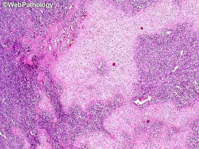 Imaging modality: Light microscopy of hematoxylin-eosin stained histology slide. The specimen is a biphasic cartilaginous-soft tissue tumor from the musculoskeletal system. Histology reveals islands of well-differentiated hyaline cartilage juxtaposed with densely cellular, small round blue cells within a highly cellular mesenchymal stroma. The cartilage islands show lacunar architecture, chondrocyte-like cells with abundant basophilic matrix, and occasional calcifications; the surrounding stroma consists of spindle to stellate undifferentiated cells with hyperchromatic nuclei and mitotic activity in some fields. This combination of chondroid differentiation and undifferentiated mesenchymal component is characteristic of mesenchymal chondrosarcoma (MC). Immunophenotype is variable; cartilage elements typically express S100, whereas the undifferentiated component may express markers of myogenic or fibroblastic lineage, requiring molecular confirmation in challenging cases. The differential diagnosis includes spindle cell/sclerosing rhabdomyosarcoma, small cell osteosarcoma, and dedifferentiated chondrosarcoma; however, MC often shows gradual blending of components and hyaline cartilage islands, unlike abrupt dedifferentiation. The HEY1-NCOA2 fusion supports MC. Clinically, MC presents in younger patients and arises in bone or soft tissue; radiographs may reveal cartilaginous calcifications. Correlating histology with imaging and, when necessary, molecular studies enhances diagnostic accuracy and informs surgical planning, chemotherapy considerations, and prognosis. This fusion-guided approach improves diagnostic confidence and guides therapy and prognosis