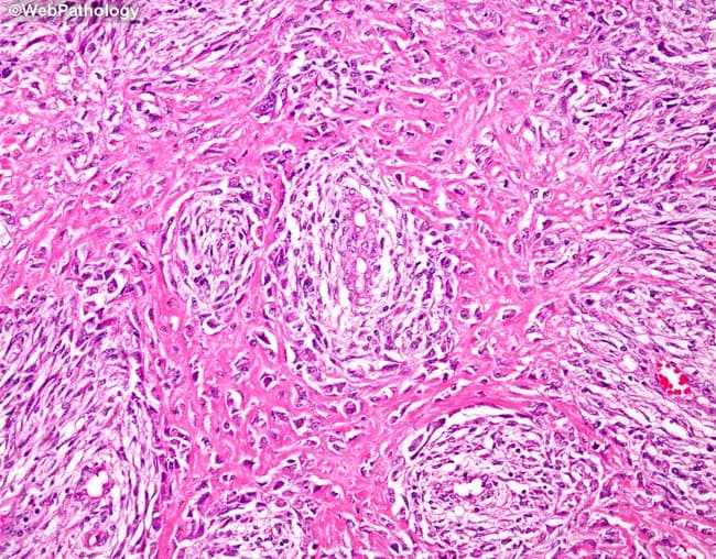 Imaging modality: histopathology section of bone tissue; Technique: hematoxylin and eosin staining; Magnification: not specified. The image depicts a malignant spindle cell neoplasm arising in osseous tissue, consistent with a fibroblastic osteosarcoma, fibroblastic subtype. Tumor cells are predominantly elongated, spindle-shaped, with oval to elongated nuclei and minimal cytoplasm. The cellular arrangement shows interlacing fascicles with a characteristic herringbone or storiform pattern, embedded in a densely eosinophilic collagenous stroma. Osteoid production is focal and variably present, with calcified, lace-like deposits evidencing osteogenic activity; in some regions osteoid is conspicuous, while in others it is scant, reflecting the reported variability of this subtype. The lesion is highly vascular, with numerous capillary and hemangiopericytoma-like vessels interspersed among the spindle cells, contributing to the conspicuous, vascularized stroma. Mitotic activity may be present but is not uniformly high across the field. These features distinguish fibroblastic osteosarcoma from fibrous histiocytoma and benign fibrous lesions; osteoid presence, even if focal, supports osteogenic differentiation. Clinically, this histology carries malignant potential with risk for local recurrence and metastatic spread, especially to the lungs; surgical excision with adjuvant therapy is typically indicated. This image exemplifies the diagnostic pathology that guides staging, prognosis, and multidisciplinary management of osteosarcoma for ongoing study.