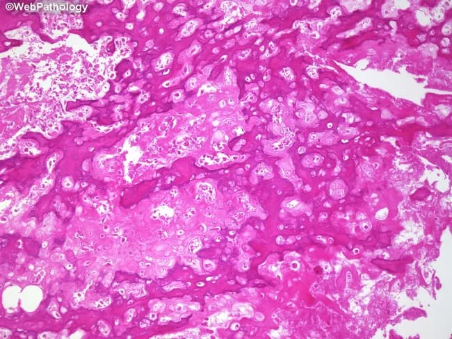 Histopathology, Hematoxylin and Eosin-stained, decalcified bone tumor section from a post-neoadjuvant chemotherapy osteosarcoma surgical resection (limb-sparing) specimen. The slide demonstrates marked sclerosis with dense bony trabeculae separating residual cellular tumor from a necrotic background. Viable tumor cells are scant and dispersed within a predominantly necrotic, fibrous/granulation tissue milieu. Coagulative necrosis is present in focal regions, with extensive cell dropout and replacement by fibrovascular stroma. Cartilage formation may be evident in chondroblastic variants, where chondroid areas show relative chemoresistance. Notable features include minimal viable osteoid-producing malignant cells, scattered hyperchromatic nuclei, and mitotic activity limited to rare foci. The overall tumor bed shows extensive remodeling, suggesting a substantial chemotherapeutic response. The pattern is characterized by sclerosis, osteoid deposition, and broad zones of scar, which can complicate accurate estimation of viable tumor volume. Clinically, this histology is used to assess response to neoadjuvant chemotherapy, an important prognostic determinant in osteosarcoma. The extent of viable tumor correlates with event-free and overall survival and informs potential adjuvant therapy decisions. This image is relevant for educational purposes, pathology practice, tumor board discussions, and research on post-treatment histologic response in pediatric and adult osteosarcoma cohorts. This final assessment guides multidisciplinary care and informs clinical trial eligibility.