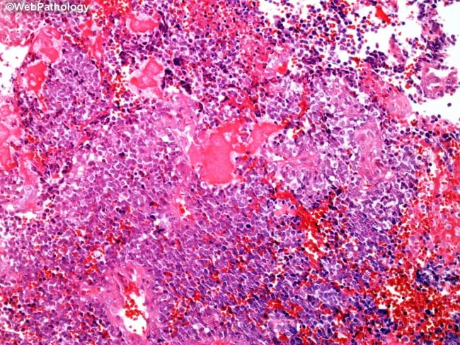 This histopathology image shows a high-grade osseous neoplasm with features suggestive of small cell osteosarcoma. The tissue is an H&E stained bone biopsy observed under light microscopy in a sagittal section of a long bone origin. The cellular population comprises small to medium-sized round to oval cells with scant cytoplasm, hyperchromatic nuclei, and prominent nucleoli; marked cellularity with focal nuclear pleomorphism. A distinctive lace-like, delicate osteoid matrix is interwoven between malignant cells, often forming lacey, trabecular strands that identify osteogenic differentiation despite a predominant small cell morphology. Osteoid is essential for distinguishing osteosarcoma from mimicking small round blue cell tumors such as Ewing sarcoma. Immunophenotype characteristic: SATB2 positive; CD99 negative; other markers may help exclude lymphoma or rhabdomyosarcoma. Molecular testing can show absence of EWSR1 and FUS rearrangements. The image may display mitoses and occasional necrosis, consistent with high-grade sarcoma. Diagnostic significance lies in differentiating from Ewing sarcoma due to treatment implications: Ewing is highly radiosensitive and often treated with radiotherapy, while small cell osteosarcoma typically requires surgical resection combined with neoadjuvant chemotherapy. Prognosis is poorer than conventional osteosarcoma. This histology is crucial for guiding multidisciplinary management, prognostication, and therapeutic planning. Correlative studies include immunohistochemistry and molecular profiling for confirmation.
