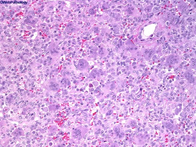Giant cell tumor of bone (osteoclastoma) histopathology. This hematoxylin and eosin stained section shows numerous multinucleated osteoclast-like giant cells dispersed among a background of uniform, oval to spindle-shaped mononuclear stromal cells. The giant cells contain multiple nuclei with scant cytoplasm, while the mononuclear cells display vesicular nuclei, fine chromatin, and limited mitotic activity. The lesion often shows a vascular, hemorrhagic background and scattered hemosiderin deposits. There is typically minimal cytologic atypia; occasional atypical mitoses may be present in more aggressive variants. Architecturally, the tissue demonstrates a proliferative stromal framework with evenly distributed giant cells and occasional mitotic figures but not overt anaplasia. This histology correlates with radiologic eccentric, radiolucent, soap-bubble–appearing lesions that arise in the epiphysis of long bones. Clinically, patients present with pain and swelling; there is a female predominance in the first two decades, with peak incidence in the third decade. The diagnosis is important to distinguish from other giant cell–rich lesions, including aneurysmal bone cyst, brown tumor of hyperparathyroidism, fibrous dysplasia, chondroblastoma, and osteosarcoma with giant cells. Immunohistochemistry may help in uncertain cases, with stromal cells often expressing RANKL and osteoclast-like giant cells being TRAP-positive. Management relies on curettage with adjuvants or en bloc resection, with recurrence risk dependent on procedure.