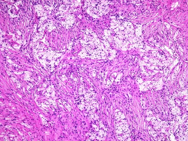 This histopathology image depicts a giant cell tumor of bone observed under light microscopy following Hematoxylin and Eosin staining. The cellular stroma consists of uniform spindle-shaped mononuclear cells interspersed with numerous osteoclast-like multinucleated giant cells. Notably, foam cells—lipid-laden macrophages—may populate the interstitium, contributing foamy cytoplasm in parts of the lesion. Giant cells contain multiple nuclei with even distribution and lack pronounced cytologic atypia; mitotic activity, if present, is typically limited. The architectural pattern can be variable, and in some cases the classic giant cell-rich areas are inconspicuous, complicating diagnosis without radiographic context. Clinically, GCTs arise in the epiphyseal/metaphyseal region of long bones in young to middle-aged adults and demonstrate local aggressiveness comparable to other bone tumors. Radiographs often reveal a soap-bubble lytic lesion with cortical thinning and expansion, providing a critical diagnostic adjunct. Differential considerations include fibrous histiocytoma and other giant cell-containing lesions. Definitive diagnosis relies on correlating histology with imaging and tumor location; immunohistochemical markers such as RANKL expression in stromal cells and tartrate-resistant acid phosphatase in giant cells can support confirmation.