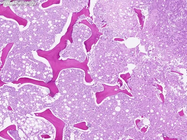 Light-microscopy histology of liver tissue demonstrates macrovesicular steatosis. Imaging modality: Histology using Hematoxylin and Eosin (H&E) stain on paraffin-embedded sections. Anatomical localization: hepatic parenchyma of the liver, with hepatocytes arranged in plates separated by sinusoids and preserved lobular architecture visible at low magnification. Visual features: numerous intracellular lipid vacuoles produce large clear droplets that displace hepatocyte nuclei to the periphery; cytoplasm otherwise eosinophilic; occasional subtle ballooning is not evident; portal tracts and central veins are discernible but not markedly inflamed. Pathological interpretation: macrovesicular steatosis consistent with fatty liver changes; most compatible with nonalcoholic fatty liver disease (NAFLD) or alcoholic fatty liver disease (AFLD) depending on patient history. In this image, steatosis is the predominant finding with minimal inflammatory infiltrate and no definitive fibrosis at this level of magnification. Clinical significance: fatty change indicates hepatocellular stress from metabolic syndrome or hepatotoxic exposure; may precede steatohepatitis, fibrosis, cirrhosis, and increased risk of hepatocellular carcinoma with ongoing injury. Potential clinical use cases: assessment of steatosis burden in NAFLD/NASH studies, biopsy-guided staging, therapeutic monitoring, and education for trainees. The image serves as an educational reference for recognizing hepatocellular lipid accumulation and distinguishing it from other hepatic pathologies such as steatohepatitis and cholestatic injury.