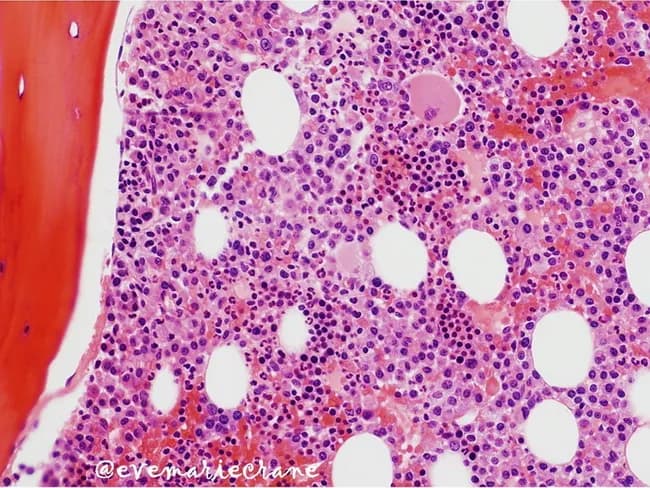 Bone marrow trephine biopsy, Hematoxylin and Eosin stained, evaluated by light microscopy. This histopathology image depicts medullary marrow with cellular admixture dominated by clonal plasma cells. Plasma cells comprise approximately 50% of nucleated cells, demonstrating interstitial (non-follicular) infiltration in a background of residual hematopoietic elements and adipocytes. The architectural pattern is interstitial rather than diffuse sheets at this stage, consistent with stage II myeloma by marrow involvement (Stage II: 20–50% replacement). The plasma cells show hyperchromatic nuclei with clumped chromatin and moderate cytoplasm; occasional binucleation may be present; cytoplasmic features not fully assessable at this magnification. Normal hematopoiesis is variably preserved in focal areas but is increasingly suppressed toward representing marrow replacement. The image correlates with increasing tumor burden and is used for staging, risk assessment, and monitoring response to therapy. In clinical practice, plasmacytosis of this magnitude suggests symptomatic multiple myeloma with potential cytopenias and immunoparesis; cytomorphology must be correlated with flow cytometry and serum/urine studies to confirm clonality. Differential considerations include reactive plasmacytosis, MGUS, and plasmacytoma; however, the extensive involvement and pattern here favor a systemic plasma cell neoplasm. This histology guides prognosis and therapeutic decisions.