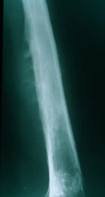 Plain Radiography of a long bone diaphysis demonstrates an aggressive, ill-defined osteolytic lesion with cortical destruction and periosteal reaction. The radiograph shows a moth-eaten destruction pattern with diffuse bone loss extending along a substantial portion of the shaft. Periosteal elevation produces Codman triangle in the swept cortex, while layered deposition of reactive new bone beneath the periosteum can create an onion-skin appearance; in some cases perpendicular radiating spicules or sunburst-like projections may be seen. The lesion often breaches the cortex or expands to form a soft tissue mass that extends beyond the bone. Although ultrasound or CT can delineate the soft tissue component, CT and MRI best characterize the extent, relation to surrounding structures, and marrow involvement. The radiographic pattern is highly suggestive of an aggressive small round blue cell tumor, most notably Ewing sarcoma, particularly in children and adolescents. Differential considerations include osteosarcoma, osteomyelitis, lymphoma, metastasis, or eosinophilic granuloma, but the combination of an diaphyseal, permeative lesion with onion-skin periosteal reaction strongly favors Ewing. Clinical correlation with pain, fever, raised inflammatory markers, and prompt biopsy is essential to confirm diagnosis and guide treatment, which typically combines chemotherapy, limb-sparing surgery, and possibly radiotherapy.