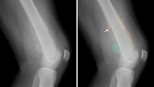 Imaging modality and technique: Plain radiography of the left distal femur and knee is performed with lateral views, showing aggressive bony lesion. Anatomy: Distal femur near the knee joint; left lower limb. Visual features: The lesion demonstrates irregular, partly destructive cortical bone with permeative medullary involvement, aggressive periosteal reaction, Codman triangle formation, an indistinct zone of transition, perpendicular spiculations producing a sunburst appearance, and a large soft tissue mass extending into adjacent compartments. Radiographic interpretation: These radiographic hallmarks strongly suggest a malignant primary bone tumor in a teenager, with Ewing sarcoma in this histologically proven case; differential includes osteosarcoma and occult infection. Clinical significance: The combination of cortical destruction, aggressive periosteal reaction, and soft-tissue extension correlates with higher tumor grade, local invasion risk, and the need for systemic staging and multidisciplinary therapy. Potential clinical uses: initial suspicion prompting MRI for local staging, CT or MRI to assess skip lesions, CT chest to evaluate metastasis, biopsy planning, treatment monitoring, and education. Context: Ewing sarcoma typically affects long bones of adolescents; this case confirms distal femur involvement with radiographic characteristics of a malignant diaphyseal/metaphyseal lesion. Additional keywords: pediatric bone tumor, onion-skin periosteal reaction (notes), EWSR1-FLI1 translocation, CD99 positivity and biopsy correlation recommended.
