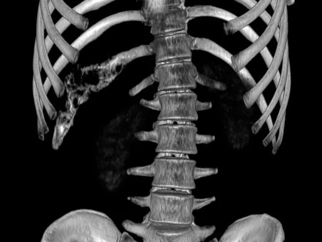Imaging modality: Computed Tomography (CT) with three-dimensional (3D) volume rendering of the chest wall. The study localizes a lytic, destructive lesion of the right 11th rib with cortical disruption and destruction extending into the adjacent chest wall soft tissues. The appearance is aggressive with permeative margins, focal cortical breakthrough, possible small soft tissue mass, and associated chest wall remodeling. No definitive matrix mineralization is noted on the given reconstruction, though an onion-skin periosteal reaction may be present in some Ewing sarcoma cases; differential considerations include Ewing sarcoma/of the chest wall, osteogenic sarcoma, osteomyelitis, metastatic neuroectodermal tumor, Langerhans cell histiocytosis, or rhabdomyosarcoma. The findings are highly suggestive of a malignant small round blue cell tumor of bone; radiologic-pathologic correlation is recommended. Imaging helps assess extent for biopsy planning, surgical resection margins, and staging workup; chest wall involvement raises prognosis considerations and chemotherapy responsiveness typical of Ewing sarcoma family tumors. This lesion is consistent with chest wall Ewing sarcoma (Askin tumor) in pediatric patients; correlation with histopathology confirms the diagnosis. The 3D CT technique provides spatial relationships to nearby pleura, lung, diaphragm, and mediastinal structures aiding thoracic surgical planning and multidisciplinary treatment.