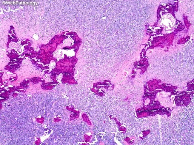 Imaging modality: Light microscopy (Histology) of bone tumor tissue. Specimen: scapular bone biopsy from a 72-year-old male. Staining: Hematoxylin and Eosin (H&E). The histologic section shows high cellularity of small round blue cells with scant cytoplasm and hyperchromatic nuclei arranged in sheets infiltrating and replacing osteolytic trabeculae. The tumor disrupts normal lamellar bone with extensive marrow invasion and focal necrosis; mitotic activity is evident. Immunophenotype usually shows diffuse CD99 membranous positivity; molecular confirmation often reveals EWSR1 gene rearrangement (e.g., EWS-FLI1), supporting Ewing sarcoma. Clinically, this lesion represents an aggressive malignant small round blue cell tumor of bone with metastatic potential; radiographic correlation commonly demonstrates moth-eaten, lytic lesions. Although Ewing sarcoma typically affects children and adolescents, this case illustrates scapular involvement in an older adult. Differential diagnoses include lymphoma, osteosarcoma with small cell features, rhabdomyosarcoma, and metastatic neuroblastoma/PNET. The image is valuable for education, radiology-pathology correlation, and differential diagnosis training in musculoskeletal oncology. Potential clinical use includes diagnostic reference, teaching file inclusion, and research into Ewing family tumors and their atypical age distribution. This microscopic image contextually complements radiographs showing bone destruction and helps in teaching differential patterns among small round blue cell tumors in the pediatric and adult skeleton.