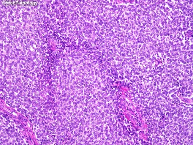 This section presents a high-magnification light microscopy image of a small round blue cell tumor, consistent with Ewing sarcoma, stained with Hematoxylin and Eosin. The specimen is a bone/soft tissue biopsy section examined under bright-field microscopy. The tumor displays sheets of uniform, small, primitive-appearing cells with round to oval nuclei, finely dispersed chromatin, and small or inconspicuous nucleoli. Cytoplasm is scant, pale eosinophilic or clear, producing a high nuclear-cytoplasmic ratio and indistinct cytoplasmic borders that contribute to a syncytial-appearing cellular nest. Mitoses are variable, sometimes brisk. Intracytoplasmic glycogen is a key feature that can be highlighted by Periodic acid–Schiff (PAS) staining (PAS-positive granules). Tumor cells frequently organize around delicate vasculature, forming pseudorosettes; true Homer-Wright rosettes may be present in some fields. The stroma is scant but vascular, and extensive necrosis can be seen as geographic areas or scattered foci. Immunophenotype is typically CD99 (MIC2) positive and molecular testing often reveals EWSR1-FLI1 or related translocations; these ancillary tests are essential for confirmation. Distinguishing from other small round blue cell tumors is critical because prognosis and therapy differ. This histologic pattern supports a diagnosis of Ewing sarcoma in the appropriate clinical context and guides multimodal treatment planning.