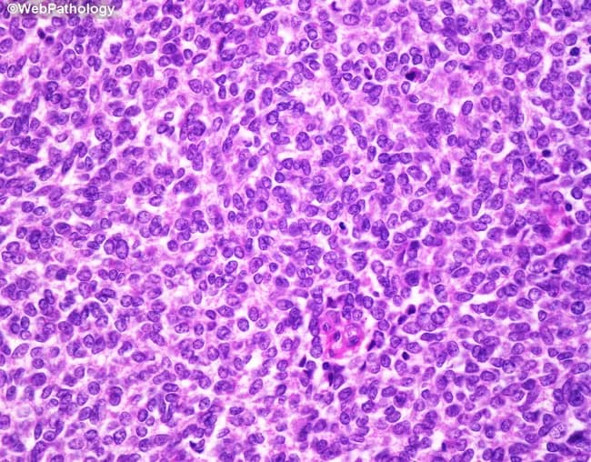 This is a light microscopy image of a bone tumor biopsy stained with Hematoxylin and Eosin (H&E). The image demonstrates the classic small round blue cell morphology of Ewing sarcoma. The tumor is composed of uniform, small, primitive-appearing cells with scant pale eosinophilic or clear cytoplasm and rounded to oval nuclei with evenly dispersed chromatin and small or inconspicuous nucleoli. Cytoplasmic borders are indistinct, producing a syncytial appearance. Mitotic activity is variable and may be increased. Intracytoplasmic glycogen is common and can be highlighted with periodic acid–Schiff (PAS) staining; this feature supports the diagnosis of this entity. The tumor cell nests may arrange around delicate vasculature to form pseudorosettes; true Homer-Wright rosettes may be present in some cases. The stroma is a delicate vascular network; necrosis is frequent, appearing as large geographic areas or smaller foci. Together these features produce a dense, sheets-and-nests pattern with a high nuclear-to-cytoplasmic ratio typical of small round blue cell tumors. The image is diagnostic when integrated with immunohistochemical and molecular studies (e.g., CD99 positivity, EWSR1 rearrangement) but the morphology shown is highly characteristic of Ewing sarcoma. This histology is pathognomonic in the appropriate clinical context and is essential for prognosis and treatment planning.