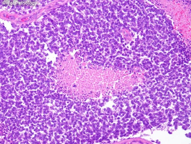 Imaging modality: Histopathology using light microscopy of formalin-fixed, paraffin-embedded bone tissue stained with Hematoxylin and Eosin (H&E). The slide displays a skeletally derived lesion with features classic for Ewing sarcoma. At high cellular density, there are sheets of small round blue cells with scant cytoplasm and round to oval nuclei showing hyperchromasia and brisk mitotic activity. The tumor cells are arranged in uniform clusters, separated by delicate fibrous strands, creating a highly cellular, often undulating landscape. Areas of geographic necrosis are frequently seen within the tumor, producing pink, acellular zones that disrupt cohesive cell architecture. Cytoplasmic scantiness and high nuclear-to-cytoplasmic ratio are typical; occasional rosette-like formations (Homer-Wright) may be present but are not required for diagnosis. The overall histologic pattern corresponds to a high-grade small round blue cell neoplasm in bone. Although not shown in this image, CD99 membrane positivity is commonly observed in Ewing sarcoma and, together with molecular testing for EWSR1-FLI1 fusion (t(11;22)) or related rearrangements, strengthens the diagnosis. Clinically, this histology correlates with aggressive bone lesions in children and adolescents and has important differential considerations including lymphoma, rhabdomyosarcoma, neuroblastoma, and osteosarcoma. Correlation with radiology and immunohistochemistry is essential for definitive diagnosis and prognostic assessment in clinical practice overall.