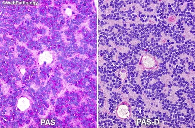 This histopathology image pair presents a bone-tumor specimen stained with PAS (left) and PAS-D (right) to highlight intracytoplasmic glycogen in Ewing sarcoma cells. The left panel shows strong magenta cytoplasmic staining within sheets of small round blue cells, consistent with PAS-positive glycogen-rich cytoplasm. The right panel demonstrates diastase digestion (PAS-D) where glycogen is hydrolyzed, and the cytoplasm adopts a pale pink to near unstained appearance, confirming glycogen as the source of PAS positivity. The tumor cells exhibit uniform, small cell morphology with high nuclear-to-cytoplasmic ratio, round to oval nuclei, delicate chromatin, and scant cytoplasm; occasional rosette-like arrangements may be observed. The two-panel comparison emphasizes the diagnostic utility of PAS-PAS-D staining in differentiating glycogen-rich Ewing sarcoma cells from other small round blue cell tumors. Pathologically, this glycogen-rich cytoplasm is a hallmark feature that supports EWSR1-related neoplasms; diastase sensitivity is key to ruling in glycogen as the substrate. Clinically, these findings are relevant for pathology workflows, differential diagnosis, and educational purposes, and they guide ancillary studies, including immunohistochemistry for CD99, NKX2.2, and molecular testing for EWSR1 rearrangements. This image is valuable for prognostic and therapeutic decision-making in pediatric and young adult bone oncology research and diagnostics, and for histology teaching in pathology curricula.