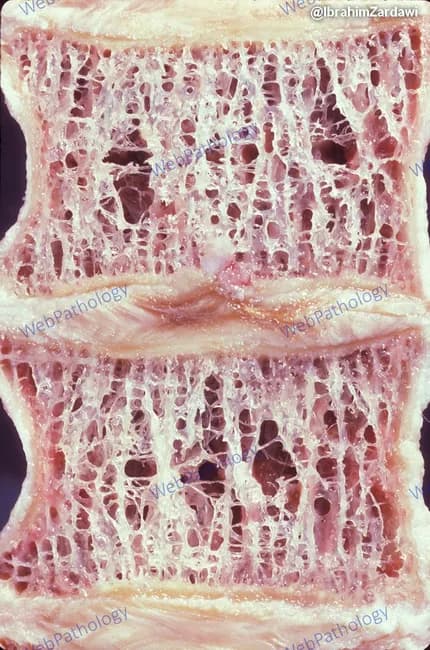 Light microscopy examination of a decalcified vertebral cancellous bone section from the vertebral body, stained with Hematoxylin and Eosin. The specimen demonstrates osteoporotic microarchitecture with thinning and dropout of bone spicules. The trabecular network shows enlarged intertrabecular spaces and extensive perforations, yielding a porous, lattice-like appearance. Horizontal trabeculae are thinner and there is loss of interconnectivity between trabecular plates, consistent with reduced bone strength. The endplates and cortical shell are variably preserved in this plane, while the marrow spaces appear expanded. These histologic features reflect diminished bone mass and compromised structural integrity. Clinically, this pattern is typical of osteoporosis or severe osteopenia, often associated with aging or postmenopausal status, and correlates with increased vertebral fracture risk. Differential considerations include disuse osteoporosis and other metabolic bone diseases when osteoid deposition or mineralization abnormalities are prominent. The diagnostic relevance lies in correlating histology with radiographic bone density (DEXA) and clinical risk factors, guiding therapy decisions such as antiresorptive or anabolic agents. This image serves educational purposes in teaching vertebral trabecular bone histology, osteoporosis pathology, and microarchitectural deterioration. Potential research applications include evaluating therapeutics aimed at preserving trabecular connectivity and vertebral strength. This histology correlates with radiographic densitometry and fracture risk in patients.