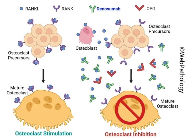This educational digital illustration depicts the RANKL-RANK-OPG regulatory axis governing osteoclast development and bone resorption. The left panel shows osteoblasts secreting RANKL (receptor activator of NF-kB ligand) that engages RANK on osteoclast precursors, promoting osteoclast maturation and bone-resorbing activity; osteoclasts become mature osteoclasts at the bone surface, initiating resorption on a cortical or trabecular bone interface. The right panel demonstrates pharmacologic inhibition by denosumab, a human monoclonal antibody that binds RANKL and prevents RANK-RANKL signaling, thereby blocking osteoclast formation, reducing resorptive function, and decreasing osteoclast survival. In this inhibited scenario, osteoblasts continue signaling but osteoclastogenesis is suppressed, leading to reduced cavitation and diminished bone turnover. The image also references osteoprotegerin (OPG) as the endogenous decoy receptor for RANKL. The layout includes legend items labeling RANKL, RANK, denosumab, and OPG, and captions Osteoclast Stimulation and Osteoclast Inhibition. Although schematic, the depiction captures clinically relevant concepts: denosumab therapy for osteoporosis and Paget disease when bisphosphonates are contraindicated (e.g., renal failure). This illustration supports educational understanding of antiresorptive therapy, mechanism of action, and pathway interactions, useful for teaching, review, and clinical discussion about bone remodeling, osteoclast biology, and targeted osteoporosis treatment. This educational figure is intended for medical students, residents, and clinicians.