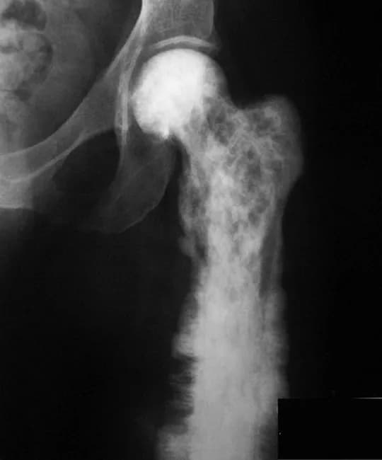 This is a plain radiograph (X-ray) of the femur demonstrating malignant transformation of Paget disease into osteosarcoma in the proximal femur. The image exhibits an aggressive, poorly demarcated lytic-destructive lesion with a permeative pattern, extensive cortical destruction, and a bulky soft tissue mass. Classic Paget disease changes are overlaid by malignant osteoid-producing tumor features, including sunburst-like periosteal reaction and Codman triangle, with a wide zone of transition. The lesion may be associated with a pathologic fracture and cortical erosion. The radiographic pattern aligns with high-grade osteosarcoma in the setting of pagetic bone; imaging may reveal mineralization within the tumor and strong aggression into surrounding soft tissues. Bone scans typically show reduced isotope uptake in lytic Pagetic regions, whereas MRI/CT could better delineate medullary involvement and soft-tissue extent. This case, attributed to The Radswiki, Radiopaedia.org (case rID: 11727), highlights the need for biopsy for definitive histology and staging. Clinically, older patients with longstanding Paget disease presenting with new, persistent pain or fracture should raise suspicion for malignant transformation to osteosarcoma; management involves oncologic assessment, surgical planning, and systemic therapy as indicated. The image is valuable for radiology education and differential diagnosis training in musculoskeletal oncology, Paget disease, and bone tumors. Utility.