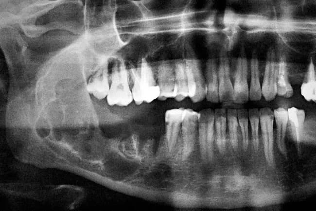 Imaging modality: dental panoramic radiography (Orthopantomogram, OPG) provides a single broad, two-dimensional view of the jaws and dentition. The lesion is located in the mandible, most likely in the posterior region, with a conspicuous radiolucent, multiloculated pattern described as a soap-bubble appearance. The borders are corticated but expanded, indicating benign but locally aggressive behavior. Teeth in the vicinity show displacement and possible root resorption; there are no radiopaque calcifications within the lesion. This radiographic phenotype is characteristic of ameloblastoma, an epithelial odontogenic tumor that comprises about 1% of jaw tumors and cysts. The differential diagnosis includes odontogenic keratocyst, central giant cell granuloma, odontogenic myxoma, and other multilocular jaw lesions. Clinically, ameloblastoma presents in young to middle-aged adults as slow-growing swelling with facial asymmetry, often without pain. Imaging assessment informs surgical planning, as complete en bloc resection or wide local excision is often required due to high recurrence rates if the lesion is incompletely removed. Correlate radiographic findings with histopathology for definitive diagnosis. The image is credited to Bulent Celasun, MD, Ankara, Turkey, with permission. This depiction reinforces radiographic hallmarks used in educational and diagnostic workflows. Biopsy confirmation remains essential to establish definitive histology and guide definitive management and long-term surveillance.