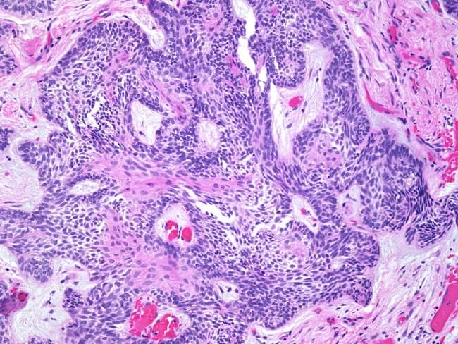 Imaging modality: light microscopy of Hematoxylin and Eosin stained, formalin-fixed, paraffin-embedded jaw tissue. The specimen shows ameloblastoma with prominent squamous metaplasia within tumor islands. Odontogenic epithelial nests exhibit peripheral ameloblast-like, tall-columnar cells with reverse polarity and a basaloid, dark-staining center resembling stellate reticulum. In many islands, there is extensive squamous differentiation with polygonal keratinizing cells and foci of keratinization, yet the cells retain minimal cytologic atypia and mitotic activity is low. The surrounding stroma is fibrous and vascular, with infiltrative margins indicating local aggressiveness characteristic of ameloblastoma. Absence of significant pleomorphism, hyperchromasia, or abnormal mitoses helps distinguish this process from squamous cell carcinoma, though extensive squamous metaplasia can mimic malignancy. The lesion is typical of an odontogenic tumor occurring in the jaw (mandible or maxilla). Clinically relevant differential diagnoses include squamous cell carcinoma arising in odontogenic keratocyst or de-differentiated ameloblastoma; correlation with radiology and clinical course is essential. The diagnostic significance lies in recognizing metaplastic squamous change to prevent misinterpretation as invasive carcinoma; complete surgical excision with careful follow-up is recommended due to potential recurrence. Clinicians should correlate with radiographic margins, molecular markers as available, and immunohistochemical profile showing p63 and cytokeratin expression patterns supporting odontogenic origin rather than carcinoma.
