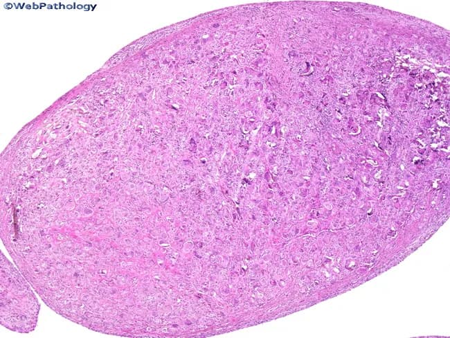 This is a light-field histopathology image of a liver biopsy section stained with Hematoxylin and Eosin (H&E). The image presents a low-magnification overview of hepatic parenchyma, showing cords of polygonal hepatocytes arranged in plates separated by sinusoidal spaces. The lobular architecture is visible, with a dense pink cytoplasmic matrix and basophilic nuclei; there is uniform cellular density without obvious necrosis, conspicuous inflammatory infiltrate, or confluent fibrotic bands at this field of view. The portal tracts are not clearly delineated in this orientation, and bile ducts or arterial branches are not readily identified. Overall liver architecture appears preserved, consistent with non-specific or normal hepatic tissue in this field. This image is suitable as an educational reference for basic liver histology, including identification of hepatocytes, sinusoids, and the hepatic lobule. Potential clinical uses include teaching hepatology and pathology, cross-reference for normal hepatic histology, and comparison against fatty change, steatosis, hepatitis, fibrosis, or cirrhosis in broader sampling. The image may be used to illustrate histological features of normal hepatic parenchyma, guide differential diagnosis when pathology is present, and enhance radiology-pathology correlation exercises in medical education. This description emphasizes reliable terminology for search indexing and clinical education.