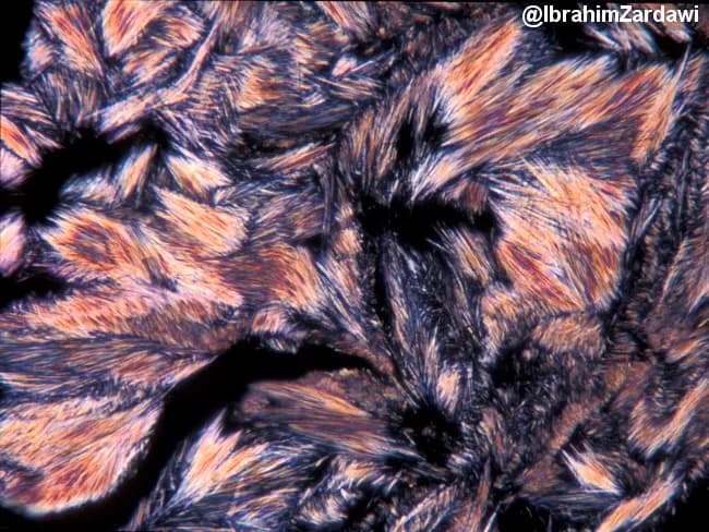 Polarized light microscopy image of monosodium urate crystals in synovial fluid from a joint, illustrating classic gout crystallography. Under cross-polarized illumination, slender, needle-shaped crystals appear colorless individually but generate bright interference colors when overlapped. These crystals are elongated with pointed termini and align to yield yellow-blue birefringence, creating a spectrum. The image showcases monosodium urate deposition, a hallmark of gout, with characteristic needle morphology and negative birefringence. The sample is not stained; polarization highlights crystalline structure and inter-crystal interference. Diagnostic significance includes definitive confirmation of gout and differentiation from calcium pyrophosphate crystals (pseudogout), which are rhomboid and weakly birefringent. Clinical relevance encompasses acute gout assessment, urate-lowering therapy decisions, and teaching crystal pathology in rheumatology education. Techniques: high magnification polarized light imaging with standard filters; interference colors reflect crystal overlap rather than stain. Credit: image courtesy of Dr. Ibrahim Zardawi. In PLM, monosodium urate crystals exhibit strong negative birefringence; their yellow-to-blue color shift depends on crystal orientation relative to the slow axis. By contrast, calcium pyrophosphate crystals in pseudogout are rhomboid and show weak positive birefringence, aiding differential diagnosis. This image is valuable for education, research on crystal pathophysiology, and confirming joint effusion analysis in rheumatologic clinics. Cited for teaching laboratories.