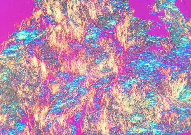 This image depicts polarized light microscopy of synovial fluid crystals from a suspected gout patient. The modality is Polarized Light Microscopy (PLM) with a first-order red compensator, producing characteristic birefringent colors. The focal specimens reveal numerous needle-shaped monosodium urate (MSU) crystals dispersed within the liquid medium, visible intracellularly and extracellularly. Under cross-polarized illumination, these MSU crystals exhibit negative birefringence: when aligned parallel to the slow red axis, they appear bright yellow, and when oriented perpendicular, they appear blue. The crystals are slender, needle-like, and variable in length, consistent with classic gout findings. The specimen type is synovial fluid obtained via arthrocentesis, and the image emphasizes the diagnostic hallmark of gout: MSU crystals in joints or tophi. Serum uric acid levels are unreliable and may be normal during an acute attack; thus, definitive diagnosis relies on crystal demonstration in joint fluid or tophus aspirates. The presence of MSU crystals supports crystal-induced inflammatory arthritis and guides therapy, including NSAIDs, colchicine, corticosteroids, and urate-lowering agents, while the clinician must still exclude septic arthritis. This image is valuable for education, microbiology and rheumatology training, and differential diagnosis exercises, illustrating crystal morphology and birefringence properties essential for accurate identification and teaching.