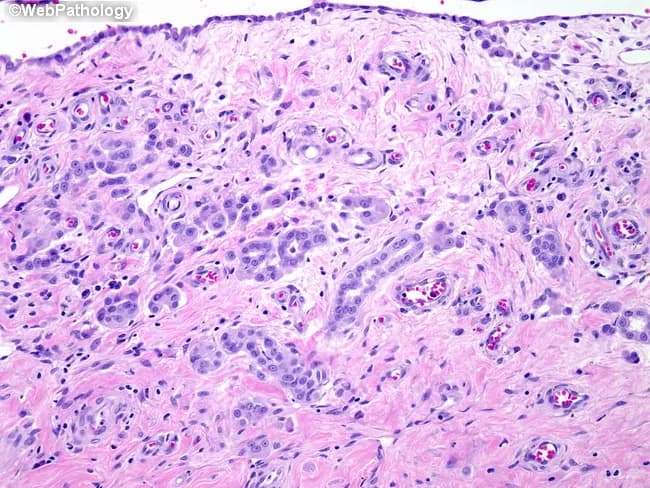 This histology slide shows reactive mesothelial hyperplasia in an orchiectomy specimen. The tissue section includes tunica vaginalis with submesothelial stroma; within this stroma, clusters of glandular-like structures are evident, lined by single to multi-layered mesothelial cells. The glands appear well-formed, with luminal spaces lined by cuboidal to flattened epithelial cells that demonstrate bland, uniform nuclei and minimal cytologic atypia. There is no cellular pleomorphism, mitotic activity, necrosis, or angular infiltration into surrounding stroma. The underlying stroma is fibrous and mildly edematous with chronic inflammatory infiltrate; no appreciable invasion of adjacent parenchyma by malignant cells is seen. The overall pattern is reactive, corresponding to chronic epididymo-orchitis as patient history; conspicuously, if the image is taken out of context, this could be mistaken for invasive carcinoma or mesothelioma due to gland-like arrangements of mesothelial cells. The complete absence of nuclear anaplasia and lack of a discrete mass favor a benign reactive process. Clinically, this finding underscores the importance of correlating histology with inflammation history and, if needed, ancillary immunohistochemistry (calretinin, WT1, CK5/6 positive for mesothelial origin; Ber-EP4, MOC31 negative or variable; PAX8 negative) to avoid misdiagnosis. This case illustrates the diagnostic challenge of mesothelial proliferations in testicular structures and guides management toward conservative interpretation.