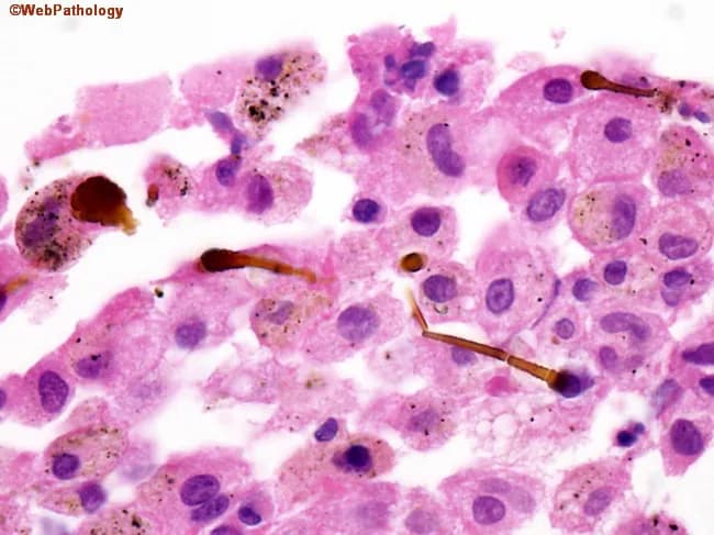 Imaging modality: Light microscopy of a paraffin-embedded, hematoxylin and eosin (H&E) stained lung tissue section. Anatomical context centers on the pulmonary parenchyma, specifically alveolar interstitium and alveolar macrophage-rich regions. Visual features include scattered ferruginous bodies—elongated, golden-brown rod fibers coated with an iron-containing shell—within macrophages and the interstitium, often appearing as dumbbell-like structures. The background may show mild interstitial inflammation and fibrosis consistent with asbestos exposure. Clinically, these histologic findings have high diagnostic significance when correlated with patient history and imaging: ferruginous bodies indicate prior asbestos exposure and raise index for asbestos-related disease, including asbestosis, lung carcinoma, and mesothelioma. This image is particularly relevant for exposure assessment in pathology, occupational health surveillance, and research on asbestos-related pathologies. If available, polarized light can enhance visualization of birefringent asbestos fibers and Prussian blue staining highlights iron in the coating. Overall, the image supports clinical risk stratification and informs management, surveillance strategies, and counseling for at-risk individuals.