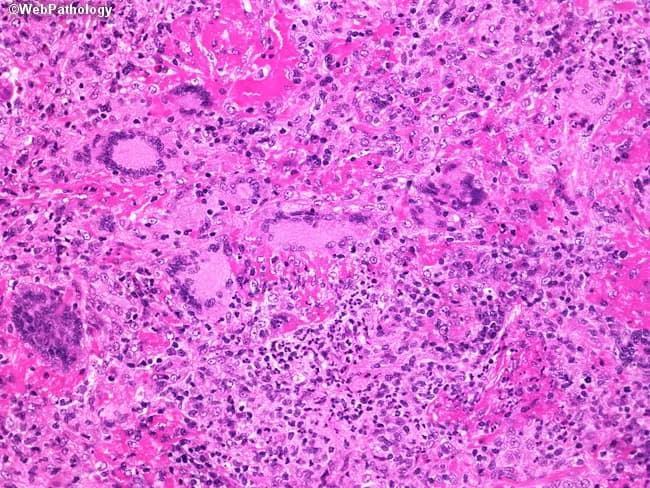 This is a hematoxylin and eosin stained liver biopsy prepared for bright-field light microscopy. Observed tissue shows hepatic parenchyma with preserved lobular architecture disrupted by a diffuse to focal inflammatory infiltrate, predominately mononuclear (lymphocytes and plasma cells) with scattered neutrophils. Inflammatory cells concentrate around portal tracts and within the hepatic lobules, consistent with portal and lobular hepatitis. The hepatocytes display variable cytoplasmic eosinophilia and occasional vacuolization; subtle hepatocellular injury is suggested but conspicuous massive necrosis is not evident at this magnification. Extracellular pink matrix outlines sinusoids and occasional endothelial cell changes; no clear well-formed granulomas are readily apparent, though small aggregates cannot be excluded. The overall pattern raises a differential diagnosis including viral hepatitis (A, B, C, E), autoimmune hepatitis, drug-induced liver injury, alcoholic hepatitis, and less likely granulomatous hepatitis or cholestatic injury. Clinically, such histology can accompany acute or chronic liver inflammation and guides further serology, imaging, and management. The findings emphasize the need for correlation with liver function tests, serology, viral panels, autoantibodies, drug history, and clinical presentation to refine diagnosis and treatment strategy. This image is valuable for education on inflammatory liver disease and differential diagnosis. It remains compatible with multiple pathologies and contributes to teaching differential histology in practice.