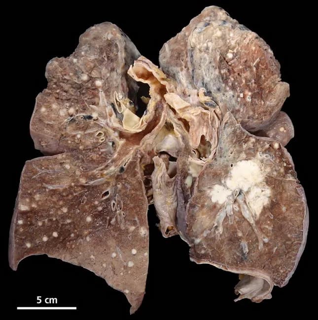 Imaging modality and specimen: Gross pathology photograph of a surgically resected lung specimen (likely right lower lobe lobectomy) illustrating invasive adenocarcinoma with extensive intrapulmonary metastases manifesting as lymphangitic carcinomatosis across both lungs and secondary bronchopneumonia of the left lower lobe. The specimen measures several inches in diameter; darker brown to tan parenchyma with multiple white nodules scattered through the lung margins and along the peribronchial/perivascular interstitium. The right lower lobe demonstrates focal tumor invasion at the hilum with contiguous soft-tissue mass; the left lower lobe shows patchy consolidation with bronchopneumonia. Microscopically, adenocarcinoma may display glandular differentiation, mucin production, and invasion into lung parenchyma, though histology is not visible in this gross image. Lymphangitic spread is indicated by nodular and band-like thickening along septa and peribronchial interstitium; this pattern correlates with rapid respiratory compromise and poor prognosis. Clinically relevant: This image supports diagnosis of primary lung adenocarcinoma as the most common non-small cell lung cancer; aligns with epidemiologic trends of increased adenocarcinoma incidence; highlights intrapulmonary metastases and associated infectious bronchopneumonia. Potential uses include medical education, radiology-pathology correlation, and gross-pathology reference in pulmonary oncology. Correlation with clinical history, imaging, and histopathology strengthens diagnostic confidence for staging and therapeutic planning in lung cancer.