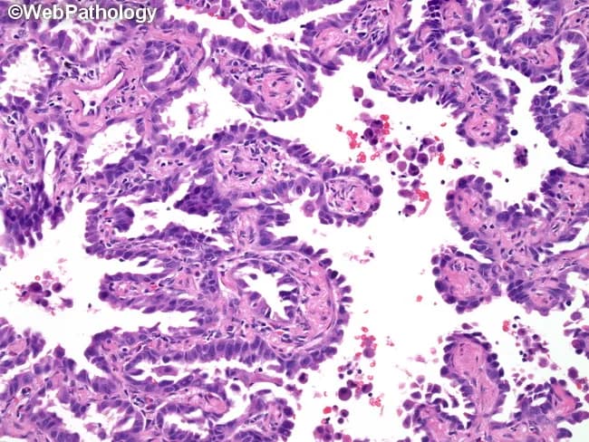 This image depicts a hematoxylin and eosin stained histology slide of lung parenchyma showing invasive non-mucinous adenocarcinoma with a lepidic growth pattern. The neoplastic epithelium lines and expands the alveolar septa with columnar to cuboidal atypical pneumocytes resembling type II pneumocytes or Clara cells. Lepidic spread is evident as neoplastic cells proliferate along preexisting alveolar walls, often preserving underlying architecture. In this specimen, components typical of lepidic growth may co-occur with minor areas showing acinar, papillary, micropapillary or solid differentiation, illustrating the histologic continuum described in contemporary classification. The lepidic areas frequently lack fibrovascular cores, contrasting with true papillary architecture; mucin production is not prominent in the shown fields. The tumor demonstrates nuclear atypia, mitotic activity may be inconspicuous, and alveolar spaces remain partly preserved by tumoral lining, contributing to a morphological impression of invasive lepidic adenocarcinoma. Correct classification requires semi-quantitative assessment of the lepidic component versus invasive patterns, as per the WHO 2015 guidelines, since prognosis and therapeutic implications depend on predominant histology. This image is relevant for pathology education, differential diagnosis discussions, and correlation with radiologic ground-glass opacities. The image serves as a reference for grading lepidic dominance and for correlating histology with radiographic patterns in thoracic oncology education and research.