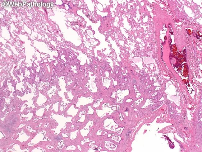 This is a histopathology slide of lung tissue prepared for light microscopy, stained with Hematoxylin and Eosin (H&E). The sample demonstrates a lepidic adenocarcinoma pattern, with neoplastic columnar epithelial cells proliferating along preexisting alveolar walls (lepidic growth) and partially preserving alveolar architecture. In the lower half of the field, neoplastic cells line and expand the alveolar septa, producing subtle crowding of nuclei with mild to moderate atypia and low mitotic activity. There is no conspicuous desmoplasia or stromal invasion evident in this view, although invasion may be focal and better assessed on additional sections. Some tumor cells show intracellular mucin. The background lung parenchyma displays relatively preserved air spaces and occasional inflammatory cells. The overall histology is compatible with lung adenocarcinoma, lepidic predominant or adenocarcinoma in situ spectrum, and could represent early invasive adenocarcinoma depending on invasion assessment in deeper sections. Clinically, lepidic growth pattern carries relatively favorable prognosis compared with other invasive adenocarcinoma subtypes when invasion is limited. This image is suitable for educational illustration of pulmonary adenocarcinoma subtypes, differential diagnosis with atypical adenomatous hyperplasia and adenocarcinoma in situ, and correlation with radiologic ground-glass opacities. Further sections may reveal invasive components not seen here. Correlation with radiologic imaging can aid staging.