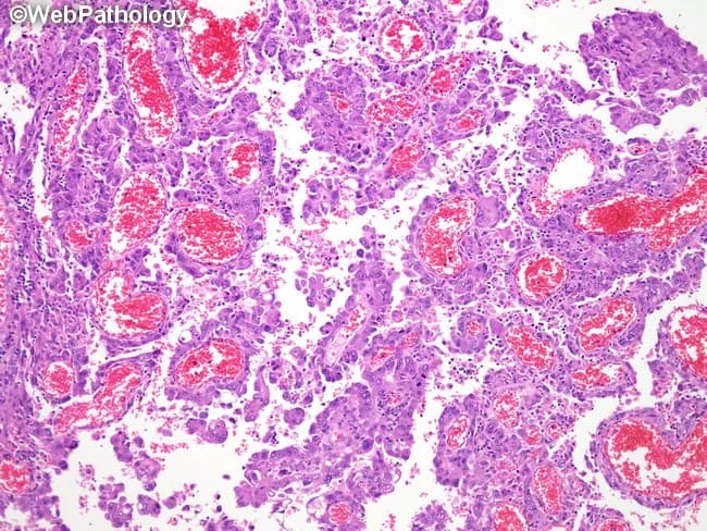Imaging modality: light microscopy of a hematoxylin and eosin (H&E) stained histology slide of lung tissue, illustrating papillary adenocarcinoma. The sampled pulmonary parenchyma displays papillary finger-like fronds projecting into alveolar spaces, each papilla built around a central delicate fibrovascular core. Epithelial cells line the cores in multiple layers, typically cuboidal to columnar in shape, with mild to moderate nuclear atypia and increased cellular density along the papillary surfaces. The tumor nests extend along alveolar septa and may detach partially, creating free-floating clusters within airspaces. The stroma between papillary fronds is scant, and vascular cores are conspicuous by red-pink stromal material on the H&E stain. Some areas show complex branching and fusion of papillae, giving a lane-like architecture. In contrast to micropapillary variants, these papillary structures retain true fibrovascular cores; however, focal lepidic or artifactual tangential sections can mimic nonpapillary growth. The overall pattern supports a diagnosis of papillary predominant adenocarcinoma of the lung, a histologic subtype of non-small cell lung cancer (NSCLC). Clinically, recognition of papillary morphology has diagnostic significance for subtype classification, prognosis, and potential molecular testing considerations (EGFR, KRAS, ALK), guiding therapeutic decisions. This histologic context informs prognosis, treatment planning, and multidisciplinary management decisions in routine diagnostic practice.