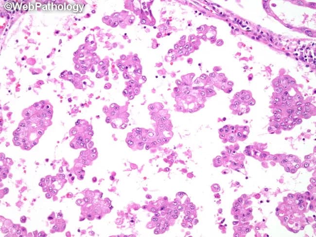 Comprehensive description of pulmonary micropapillary adenocarcinoma histology depicted in a hematoxylin and eosin stained lung tissue micrograph. The primary subject is malignant gland-forming epithelium of the lung with micropapillary tufts lacking true fibrovascular cores, often shed into alveolar spaces, producing small, floating clusters within airspaces. Tumor cells are cuboidal to columnar, with variable nuclear atypia and high nuclear-to-cytoplasmic ratio; mitotic activity may be present but not always prominent. In addition to micropapillary structures, there may be ring-like glandular configurations within the airways and alveolar lumina; occasional psammoma bodies can be observed. The architectural pattern shows tight, disconnected clusters within desmoplastic stroma, increasing invasiveness. This variant is associated with aggressive clinical behavior, including a propensity for intralobar satellite nodules, early dissemination, and frequent metastases to contralateral lung, mediastinal lymph nodes, bone, and adrenal glands. Molecular profiling in micropapillary adenocarcinoma of the lung frequently reveals mutations in KRAS, EGFR, and BRAF, informing prognosis and potential targeted therapy. Clinically, recognition of this pattern influences staging, surveillance, and treatment planning, and underscores the need for comprehensive sampling to detect multifocal disease. This image exemplifies diagnostic features useful for surgical pathology, tumor stratification, and educational reference in thoracic oncology. This pattern warrants comprehensive molecular testing.