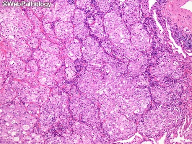 This histopathology image demonstrates solid-predominant adenocarcinoma of the lung. Acquired from lung parenchyma, formalin-fixed paraffin-embedded tissue stained with Hematoxylin and Eosin, the tumor shows solid sheets of neoplastic cells with high cellularity, minimal glandular differentiation, and no distinct lepidic, acinar, papillary, or micropapillary growth patterns in the observed fields. Intracellular mucin can be demonstrated with histochemical stains in at least 5% of cells across two high-power fields, though mucin expression may be absent in tumors that express pneumocyte markers such as TTF-1 or Napsin A. The morphology here suggests an aggressive phenotype, often correlating with larger tumor size, lymph node involvement, and invasion of lymphovascular and pleural spaces. The typical genomic profile for solid-predominant adenocarcinoma includes a lower frequency of EGFR mutations, higher rates of KRAS mutations and RET fusions, and a sizable pan-negative subset for common drivers. Clinically, this subtype informs prognosis and therapy planning, warranting comprehensive molecular testing and thorough radiologic-pathologic correlation to guide management and surveillance. This image is a representative teaching exemplar for histology and pathology education in pulmonary oncology. It is suitable for teaching lung cancer histology, differential diagnosis including mucinous subtypes, and the integration of morphologic findings with molecular testing for personalized therapy planning.