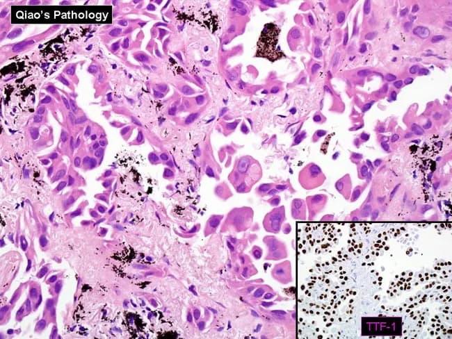 Histopathology image depicts primary non-mucinous lung adenocarcinoma with a lepidic growth pattern. Hematoxylin and eosin stained sections show cuboidal to low-columnar malignant cells lining alveolar septa and projecting into alveolar spaces, creating a characteristic lepidic architecture with preservation of alveolar outlines and minimal desmoplasia. Scattered anthracotic pigment granules are present within the alveolar septa and spaces. The inset immunohistochemical panel demonstrates strong nuclear positivity for TTF-1 in tumor cells, supporting a pulmonary origin and helping differentiate from metastatic carcinomas that are typically TTF-1 negative (with exceptions such as some thyroid metastases). The described immunoprofile of primary lung adenocarcinoma commonly includes CK7+, TTF-1+, Napsin A+, EMA+, CEA+, with CK20-, CDX2-, MUC2- in many cases, though CDX2 can be positive in mucinous variants. Overall, the image emphasizes non-mucinous histology, lepidic polarity, and the diagnostic value of TTF-1 staining for establishing a primary lung adenocarcinoma versus metastasis. Clinically relevant for diagnosis, prognosis assessment, and guiding molecular testing and therapeutic planning.