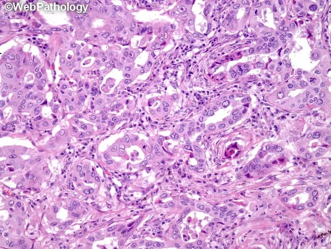 Histopathology: Light microscopy of hematoxylin and eosin stained lung tissue demonstrates an adenocarcinoma with an acinar (gland-forming) growth pattern. Tumor cells are cuboidal to columnar with moderate cytoplasm, nuclear atypia, hyperchromasia, and conspicuous nucleoli arranged in small to medium sized glands that produce mucin. Signet ring cell appearance may be present in some glands, and cribriform and occasional solid areas can be observed within the neoplasm. The surrounding lung parenchyma shows desmoplastic stroma and invasion consistent with invasive adenocarcinoma. Although ALK translocations are characteristic of a subset of lung adenocarcinomas, correlate immunohistochemical and molecular studies because ALK protein expression may be low and yield false negative results on IHC; confirmatory testing by fluorescence in situ hybridization or next generation sequencing for ALK rearrangement is recommended. Clinically, ALK rearranged tumors commonly arise in never smokers or light smokers and tend to occur in younger patients, with a tendency toward mucin production and mucinous histology. Therapeutic relevance is high because ALK inhibitors (crizotinib, ceritinib, alectinib) offer targeted treatment options. This image best illustrates acinar predominant lung adenocarcinoma, a histologic subtype that informs prognosis, molecular profiling, and treatment planning including consideration of targeted therapy. This image serves as a reference for pathology education.