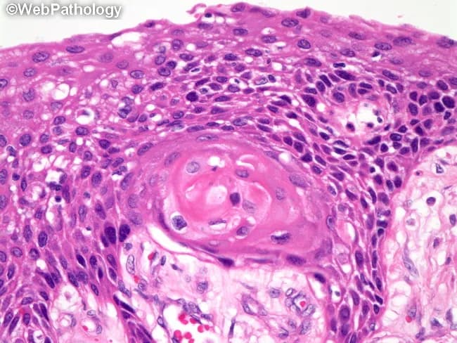 Imaging modality: Light microscopy of a hematoxylin and eosin stained tissue section, often obtained by biopsy. The slide demonstrates conventional histology of a keratinizing squamous cell carcinoma with well-differentiated epithelial nests infiltrating the surrounding stroma. Tumor cells are polygonal with abundant eosinophilic cytoplasm and intercellular bridges; keratinization is evident as keratin pearls within tumor nests. The basal layer shows increased mitotic activity and nuclear atypia, with occasional keratinizing halos surrounding nests. In focal areas, intracellular mucin may be present in scattered tumor cells, adding diagnostic nuance. The overall architecture includes cohesive nests of malignant squamous cells, keratin formation, and a fibrous stromal response. Immunohistochemistry would support squamous lineage if keratinization is less prominent or ambiguous, with p40, p63, CK5/6 positivity favoring squamous differentiation and TTF-1 negativity helping exclude pulmonary adenocarcinoma or other TTF-1 expressing tumors. Clinically, this pattern correlates with a well-differentiated squamous carcinoma that tends to show better differentiation than non-keratinizing variants but still requires complete excision or staged therapy based on invasion depth and anatomic site. This image is representative for pathology education, tumor grading, and diagnostic pathology workflow, illustrating classic keratinization, keratin pearls, and intercellular bridges characteristic of well-differentiated keratinizing squamous cell carcinoma.