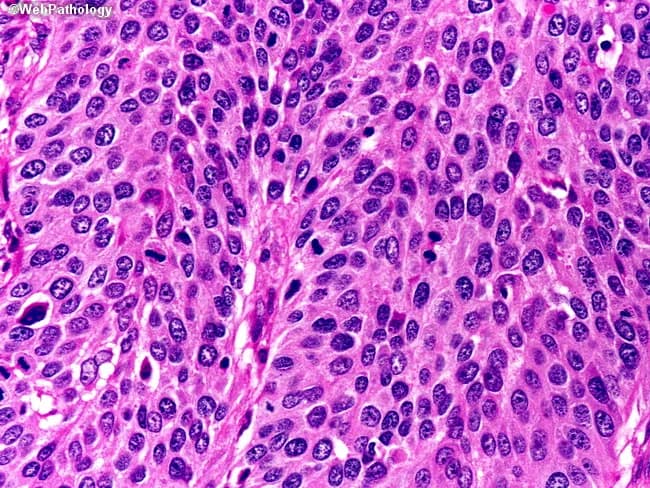 Comprehensive Description: This high-magnification light microscopic image depicts invasive cutaneous squamous cell carcinoma, moderately differentiated, derived from a skin biopsy stained with Hematoxylin and Eosin. Total magnification is approximately 400x (40x objective with 10x ocular). Tumor tissue forms irregular nests and interconnecting cords of polygonal keratinocytes infiltrating the dermal stroma, with invasive fronts delineated by jagged borders. The malignant cells exhibit pleomorphism, enlarged hyperchromatic nuclei, conspicuous nucleoli, and abundant eosinophilic cytoplasm. Increased mitotic activity is evident, and there is evidence of squamous differentiation with intercellular bridges; focal keratinization may yield keratin pearls in some areas. The tumor front is infiltrative, often accompanied by desmoplastic stromal reaction and a modest inflammatory infiltrate at the periphery. Epidermal involvement with extension toward adnexal structures can be observed, reflecting true invasion rather than in situ change. Overall, the histologic pattern supports a diagnosis of invasive cutaneous SCC with moderate differentiation, suggesting intermediate keratinization and nuclear atypia and a propensity for local invasion. Clinically, this finding informs surgical margins, staging, and prognosis, and is relevant for differential with basal cell carcinoma, keratoacanthoma, and melanoma in cutaneous lesions, as well as for educational and research contexts in tumor biology.