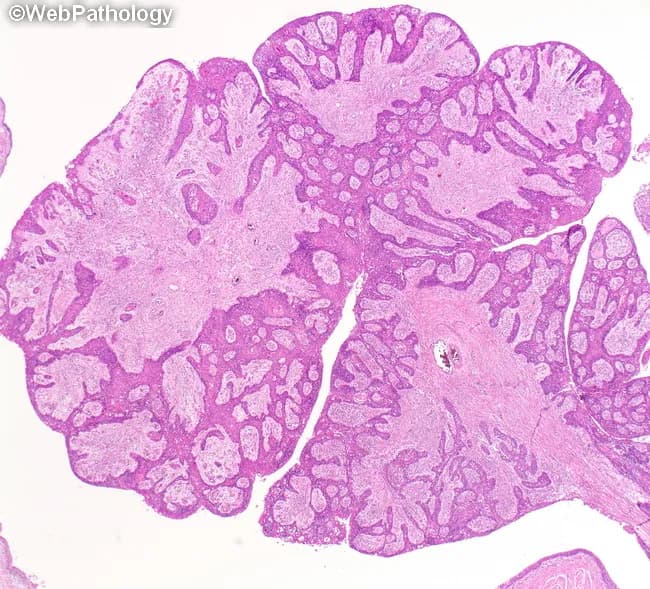This histopathology image depicts a central lung squamous cell carcinoma with a prominent endobronchial polypoid/papillary component. Acquired from lung tissue with central airway involvement, the specimen is prepared as a Hematoxylin and Eosin stained slide and examined under light microscopy at low to intermediate magnification. The architecture shows nests and sheets of malignant squamous cells arranged in a papillary to polypoid configuration within the bronchial lumen, with focal invasion into submucosa and adjacent parenchyma. Tumor cells exhibit classic squamous differentiation, including intercellular bridges, nuclear pleomorphism, prominent eosinophilic cytoplasm, and occasional keratinization with keratin pearl formation. The lesion projects into the bronchial lumen, causing obstruction and potential secondary atelectasis, bronchiectasis, and obstructive bronchopneumonia in surrounding lung segments. This central, endobronchial growth pattern is characteristic of squamous cell carcinoma of the lung, which commonly arises in smokers and tends to present with hemoptysis, cough, or recurrent infections due to airway obstruction. Differential considerations include other central neoplasms such as adenosquamous carcinoma, small cell carcinoma, carcinoid tumor, and inflammatory polyps; histology favors squamous differentiation. Clinically, findings guide bronchoscopic debulking, surgical resection considerations, radiotherapy, and chemotherapy planning. Accurate histopathologic subtyping has implications for prognosis and targeted therapy decisions, including assessment for p63/p40 positivity and keratinization.