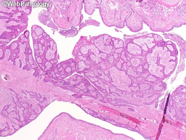Modalities and techniques: Light microscopy of paraffin-embedded lung tissue stained with Hematoxylin and Eosin (H&E). The specimen comprises bronchial mucosa overlaid by invasive squamous cell carcinoma, arising centrally from a main or lobar bronchus with a conspicuous endobronchial polypoid component. Histologic features include nests and radiating cords of malignant squamous cells with intracellular bridges, variable keratinization, and occasional keratin pearls, infiltrating the bronchial wall and adjacent parenchyma. The tumor produces luminal obstruction, which commonly leads to postobstructive atelectasis, obstructive bronchopneumonia, and bronchiectasis downstream. The architecture shows a well to moderately differentiated squamous phenotype, with intercellular cohesion, desmosomal attachments, and brisk mitotic activity in solid and papillary regions. Lumen may be partially occluded by polypoid mass projecting into the bronchial lumen. Immunohistochemical stains optional to confirm squamous differentiation (p40, p63 positive; TTF-1 negative). Pathological significance: central endobronchial squamous cell carcinoma is associated with smoking history and presents with cough, hemoptysis, and recurrent infections; differential includes other central lung neoplasms and inflammatory polyps. Clinical correlation: radiology may show central mass with airway collapse; management includes endobronchial debulking and surgical resection with adjuvant therapy. This image is diagnostic for central airway obstruction by squamous histology and serves as valuable educational material for pathology, oncology, pulmonology, radiology, and thoracic surgery teams.