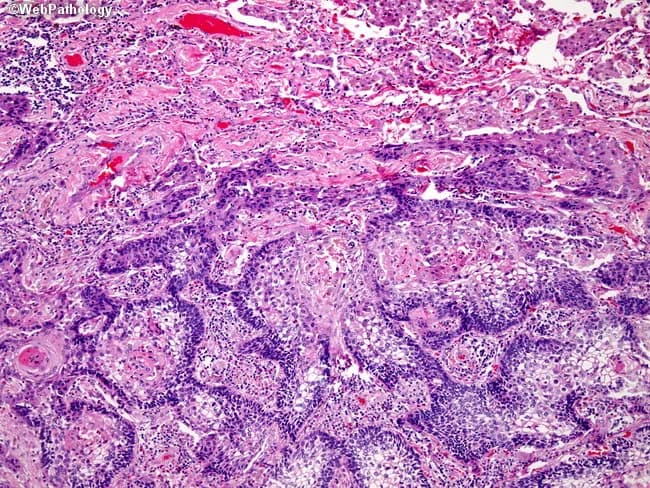 Imaging modality and technique: Histopathology via light microscopy of Hematoxylin and Eosin stained lung tissue. Primary subject: basaloid squamous cell carcinoma of the lung, with interanastomosing cords of basaloid cells and focal central squamous differentiation. Specimen: paraffin-embedded pulmonary biopsy section, representing tumor infiltrating lung parenchyma. Observed architecture comprises intricate, branching cellular cords embedded in a fibrous stroma, with nests of small, hyperchromatic basaloid cells and scant cytoplasm; occasional abrupt keratinization or squamous pearls in central zones. Adjacent lung parenchyma appears compressed and distorted at the superior edge of the image, consistent with tumor expansion. Cytology shows marked pleomorphism, high mitotic rate, and apoptotic debris; mitotic figures may be present. Overall pattern aligns with basaloid variant of squamous cell carcinoma, known for aggressive clinical behavior and relatively poor prognosis compared with conventional SCC. Diagnostic significance: recognition of basaloid differentiation informs prognosis, guides multimodal therapy, and prompts thorough staging for potential nodal involvement and distant metastasis. Potential differential diagnoses include conventional squamous cell carcinoma with basaloid features, small cell carcinoma with basaloid aspects, and large cell carcinoma variants; histology helps distinguish via keratinization and morphological context. Clinical correlation: correlates with rapid disease progression; supports consideration of aggressive surgical and systemic treatment alongside radiotherapy.