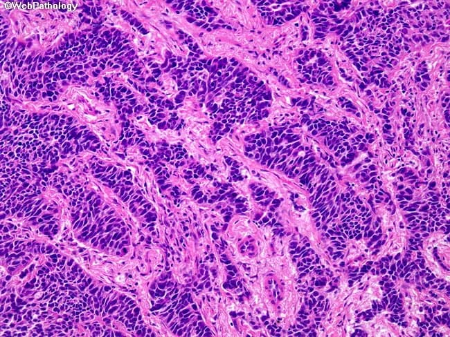 Imaging modality: Histopathology, light microscopy of formalin-fixed, paraffin-embedded lung tissue stained with Hematoxylin and Eosin (H&E). The specimen reveals a malignant neuroendocrine tumor of the lung, classically described as small cell carcinoma. The tumor shows cohesive nests and interconnecting cords with scant cytoplasm and hyperchromatic nuclei; nuclear molding; finely textured chromatin with indistinct nucleoli. Cells are round to spindle-shaped and often display high nuclear-to-cytoplasmic ratio. The stroma is minimal, with frequent mitotic figures and areas of necrosis; crush artifacts may be present. The pattern is characteristic of a high-grade neuroendocrine carcinoma, typically with high cellularity and limited stromal support. Immunohistochemistry, while not visible in the image, commonly demonstrates neuroendocrine markers (synaptophysin, chromogranin, CD56) and TTF-1 positivity in many cases; the Ki-67 index is high. Clinically, this diagnosis indicates an aggressive neoplasm with rapid growth and early metastatic potential, necessitating systemic platinum-based chemotherapy with possible radiotherapy and comprehensive staging. Differential considerations include other small blue cell tumors of the lung such as lymphoma, atypical carcinoid, and poorly differentiated squamous cell carcinoma. Correlation with radiologic imaging and, when available, molecular studies is essential for definitive classification and appropriate treatment planning. This description supports diagnostic accuracy and informs multidisciplinary management decisions for care.