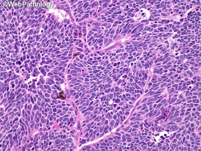 Imaging modality: light microscopy of hematoxylin and eosin (H&E) stained lung tissue biopsy; specimen: lung parenchyma, central airways, consistent with small cell lung carcinoma (SCLC). The histology shows sheets and clusters of very small round to oval cells with scant cytoplasm and ill-defined borders, resulting in a high nuclear-to-cytoplasmic ratio. Nuclei are hyperchromatic with finely dispersed granular chromatin described as salt-and-pepper, and nucleoli are absent or inconspicuous. Nuclear molding is a constant and defining feature, with intimate contiguity of nuclei that distorts cell borders. Mitotic activity is brisk and necrosis is commonly present, reflecting the high-grade nature of SCLC, which by definition is high-grade and lacks a conventional grading scale. The tumor often displays crush artifact and necrotic debris in intercellular spaces. The morphology helps distinguish SCLC from non-small cell carcinoma, where chromatin tends to be clumpy and nucleoli are more conspicuous. Immunohistochemistry may further support diagnosis, with neuroendocrine markers such as synaptophysin, chromogranin A, and CD56 typically positive, and TTF-1 often variably expressed. Clinically, these findings correlate with aggressive behavior, early metastatic potential, and a treatment paradigm dominated by systemic chemotherapy and radiotherapy. The image is essential for education and reference in pathology, oncology, and thoracic medicine. Educational reference material.