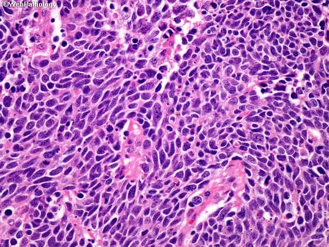 Imaging modality: Light microscopy of hematoxylin and eosin (H&E) stained lung tissue section. Primary subject: small cell lung carcinoma (SCLC) tumor cells derived from bronchogenic carcinoma. Specimen: bronchial/lung parenchyma biopsy; histologic section prepared from paraffin-embedded tissue, typically 4-5 micrometers thick. Imaging perspective: high-magnification cellular view under brightfield illumination. Visual features: the tumor shows dense sheets and clusters of small, round to oval cells with scant cytoplasm and ill-defined cytoplasmic borders, producing a densely packed, blue-gray appearance on H&E. Nuclei are hyperchromatic with finely dispersed granular chromatin giving a salt-and-pepper pattern; nucleoli are absent or inconspicuous. Nuclear molding is a constant finding. Mitotic activity is markedly increased, with numerous mitotic figures; necrosis is commonly present within tumor nests. The morphology is that of a high-grade neuroendocrine carcinoma, with little cytoplasm and abrupt cell borders. Background tissue often contains necrotic debris and crush artifacts near tumor clusters. This histology supports differentiation from non-small cell lung carcinomas, in which chromatin may be coarser and nucleoli more conspicuous. Clinically, SCLC is aggressive with early metastatic potential and a distinct therapeutic approach; histology guides diagnosis, prognosis, staging, and treatment planning, including chemotherapy and radiotherapy regimens and consideration of paraneoplastic syndromes.