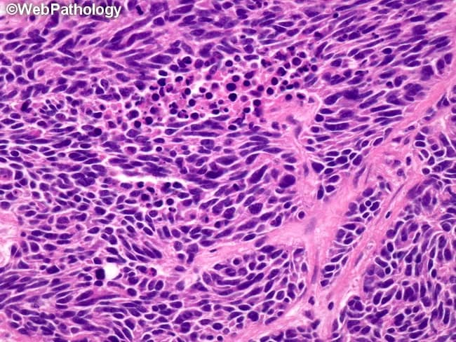 Imaging modality and technique: Brightfield light microscopy of a hematoxylin and eosin–stained lung biopsy section. Primary subject: small cell carcinoma of the lung (SCLC), a high‑grade neuroendocrine carcinoma commonly arising centrally in smokers. Specimen: bronchoscopic or percutaneous core biopsy tissue displaying dense cellularity within lung parenchyma. Morphologic features: numerous small, round to oval cells with scant cytoplasm and ill‑defined borders, forming sheets and clusters. Nuclear characteristic: hyperchromatic, finely dispersed salt‑and‑pepper chromatin with absent or inconspicuous nucleoli and pronounced nuclear molding. Cytoplasm is tenuous, giving a characteristic high nuclear‑to‑cytoplasmic ratio. Mitotic activity is brisk with frequent atypical mitoses; extensive necrosis is often present, contributing to geographic tumor necrosis on histology. Background stroma is usually fibrotic or desmoplastic, and crush artifacts may accentuate nuclear crowding. These features collectively define a high‑grade phenotype with aggressive biology. Diagnostic significance: when present, these findings support SCLC diagnosis and guide rapid systemic chemotherapy and radiotherapy planning. Context and differential: morphological distinction from non‑small cell lung carcinoma relies on chromatin pattern (finely dispersed, no clumps) and nucleoli, rather than nuclear size or neuroendocrine differentiation. Correlation with immunohistochemistry (e.g., synaptophysin, chromogranin A) reinforces the diagnosis and informs prognosis and treatment planning.