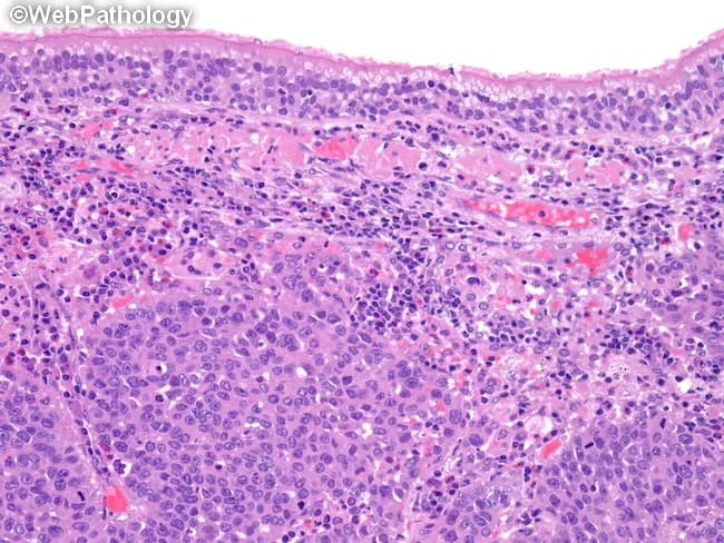This is a hematoxylin and eosin stained histopathology image of a large cell neuroendocrine carcinoma (LCNEC) of the lung, rendered as a paraffin-embedded tissue section viewed under light microscopy. The specimen originates from pulmonary parenchyma and displays classic high-grade neuroendocrine tumor architecture with sheets or nests of large polygonal cells. Tumor cells have abundant cytoplasm, coarse to vesicular nuclear chromatin, prominent nucleoli, and frequent mitotic figures. Nuclear molding and geographic necrosis are common, imparting a highly anaplastic appearance. The appearance closely resembles small cell lung carcinoma in aggressiveness but is distinguished by larger cell size and more cytoplasm. The neoplasm often demonstrates neuroendocrine differentiation; immunohistochemical studies would typically reveal positivity for neuroendocrine markers (synaptophysin, chromogranin A, CD56) and a high Ki-67 proliferation index. Molecularly, LCNEC frequently harbors inactivation of TP53 and RB1, paralleling SCLC molecular pathogenesis and differing from carcinoids. Clinically, this lesion portends a poor prognosis and requires aggressive management, often involving platinum-based chemotherapy, immunotherapy considerations, and staging to exclude metastatic disease. This image is valuable for illustrating the histomorphologic hallmarks, aiding differential diagnosis against carcinoids and poorly differentiated NSCLC, and illustrating the molecular-pathology correlation that informs prognosis and therapeutic strategy.